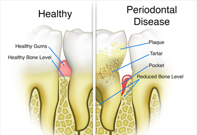 Tooth and Bone Loss