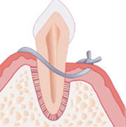 Osseous Surgery