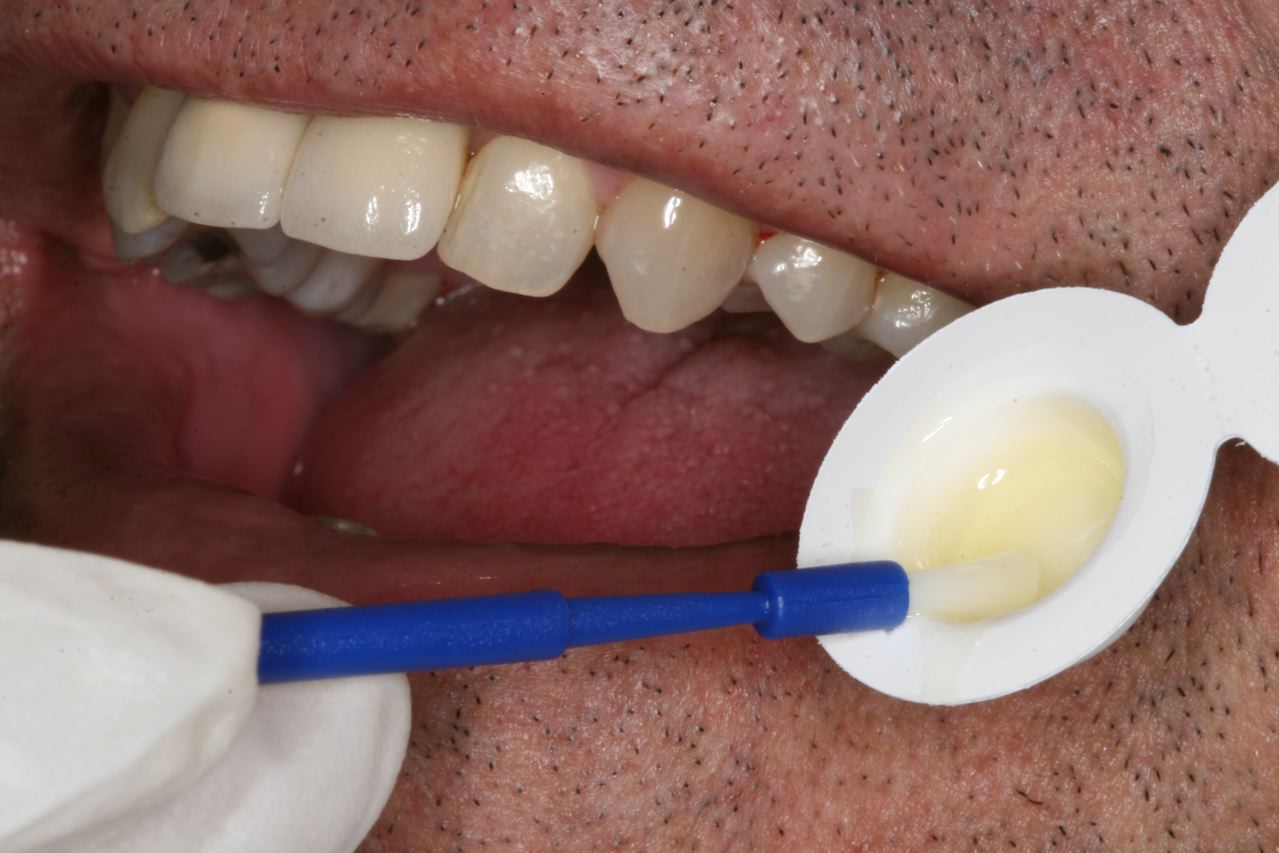 Fluoride Varnish